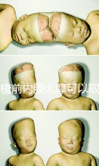 移植前內膜太厚可以取卵早知道,疼痛因人而異