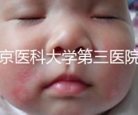 北京醫(yī)科大學(xué)第三醫(yī)院nt檢查費(fèi)用盤點(diǎn)需要多長(zhǎng)時(shí)間,是否預(yù)約